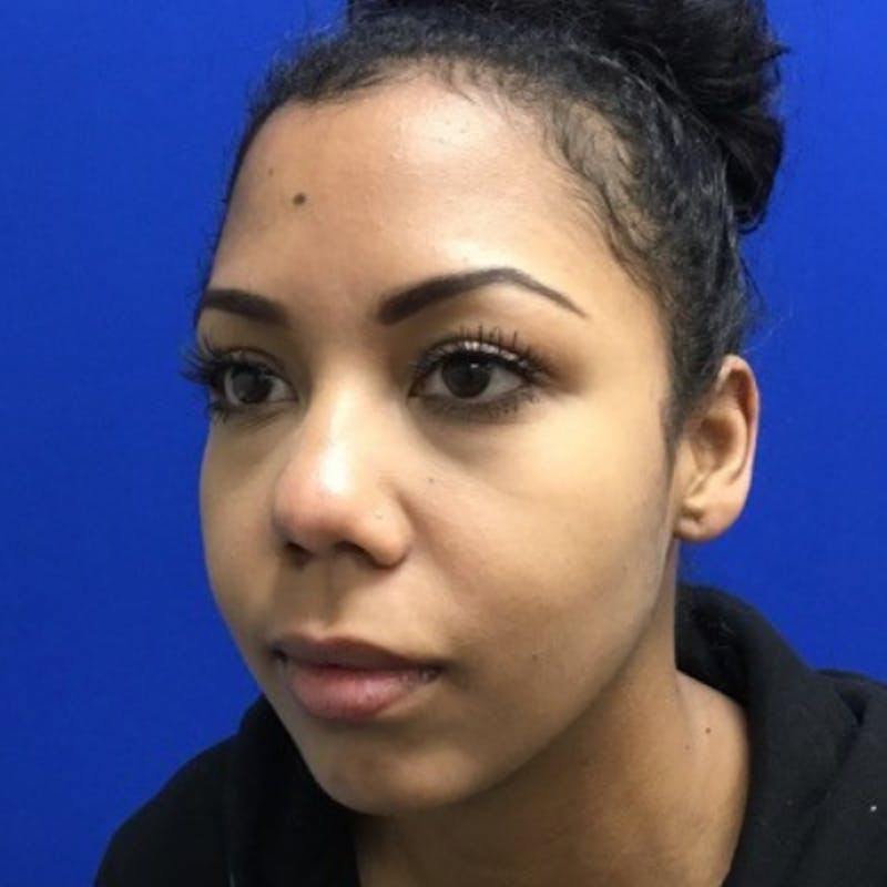 Face Before & After Gallery - Patient 63360850 - Image 1