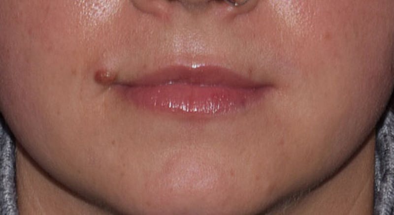 Cosmetic Surgical Before & After Gallery - Patient 63360851 - Image 1