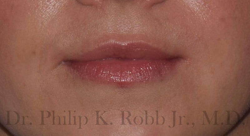 Face Before & After Gallery - Patient 63360851 - Image 2
