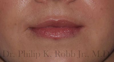 Cosmetic Surgical Before & After Gallery - Patient 63360851 - Image 2