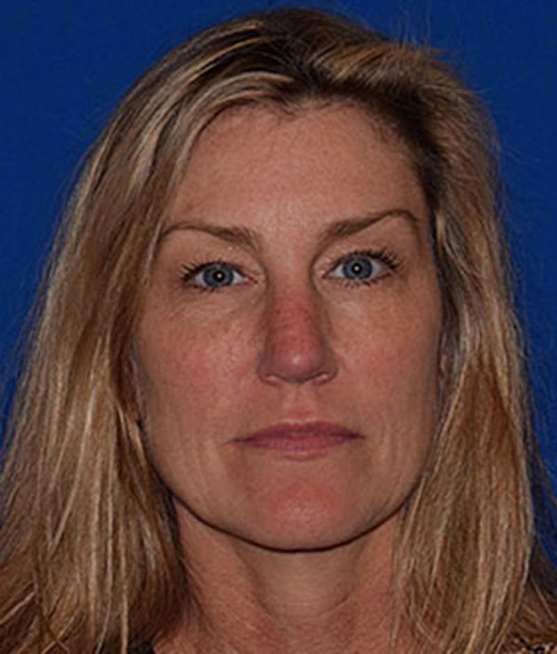 Face Before & After Gallery - Patient 63360852 - Image 1