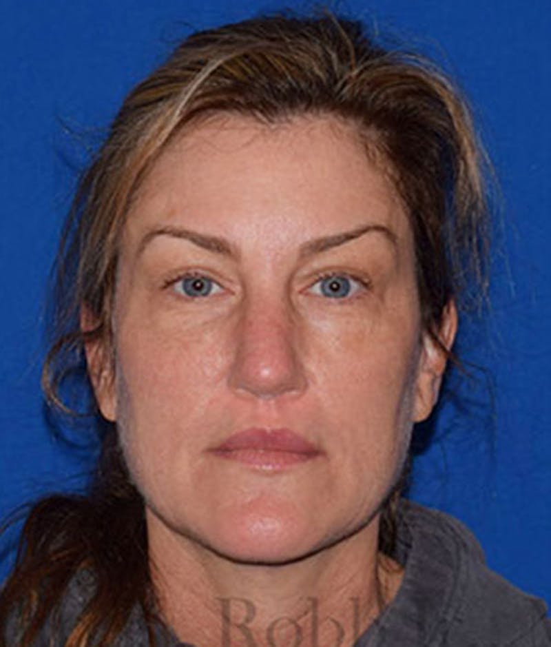 Face Before & After Gallery - Patient 63360852 - Image 2