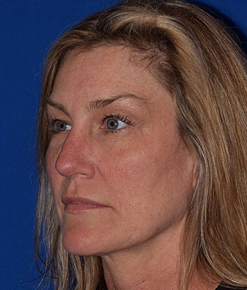 Face Before & After Gallery - Patient 63360852 - Image 3