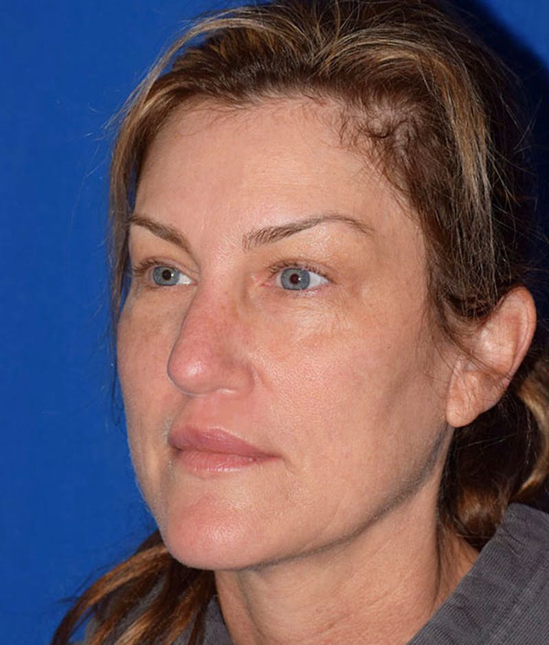 Face Before & After Gallery - Patient 63360852 - Image 4