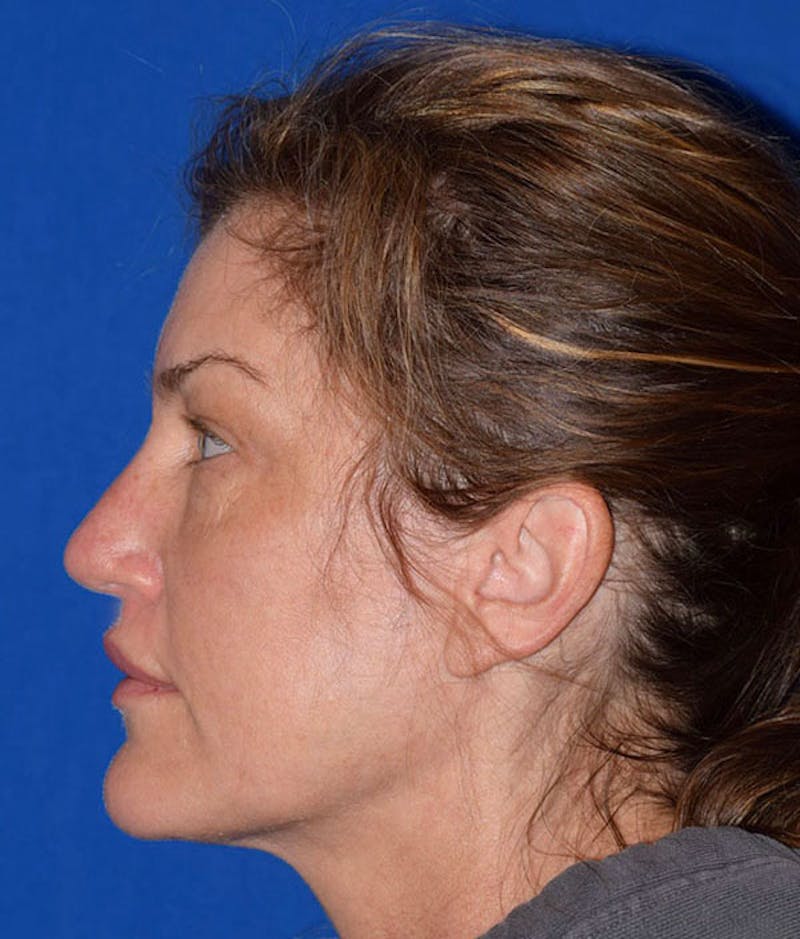 Face Before & After Gallery - Patient 63360852 - Image 6