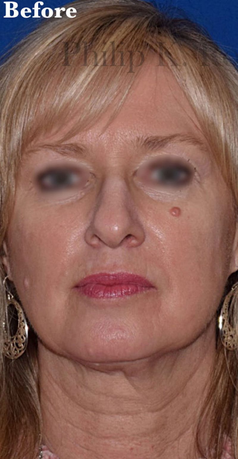 Face Before & After Gallery - Patient 63360854 - Image 1