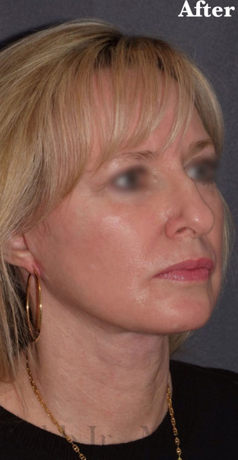 Face Before & After Gallery - Patient 63360854 - Image 4