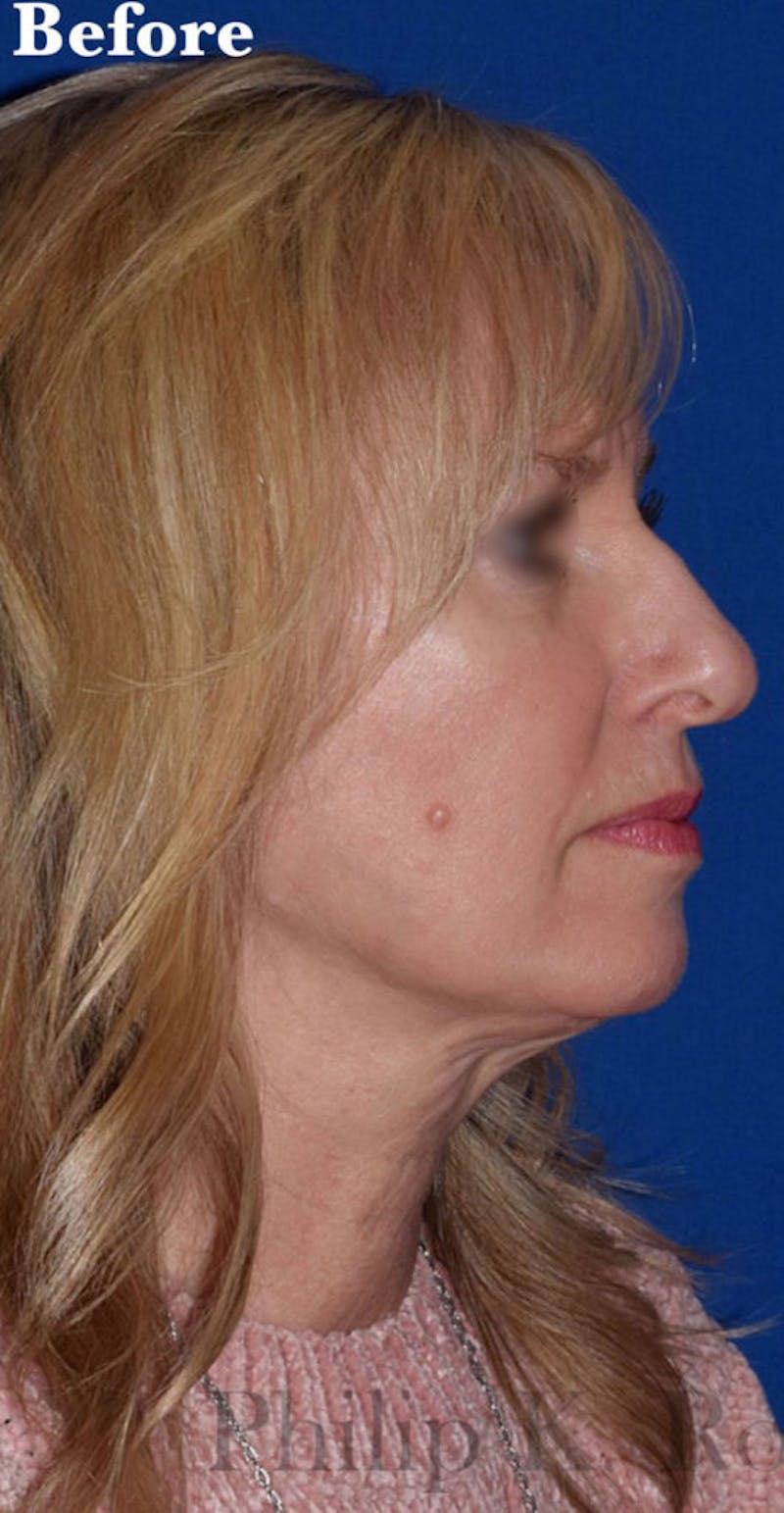 Face Before & After Gallery - Patient 63360854 - Image 5