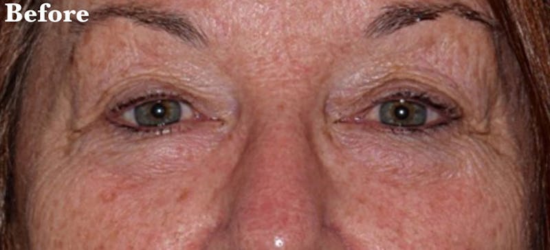Face Before & After Gallery - Patient 63360858 - Image 1