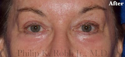 Face Before & After Gallery - Patient 63360858 - Image 2