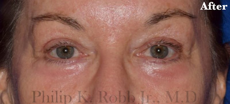 Face Before & After Gallery - Patient 63360858 - Image 2