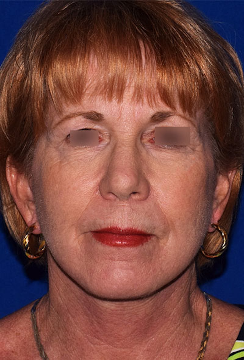 Face Before & After Gallery - Patient 63360865 - Image 2