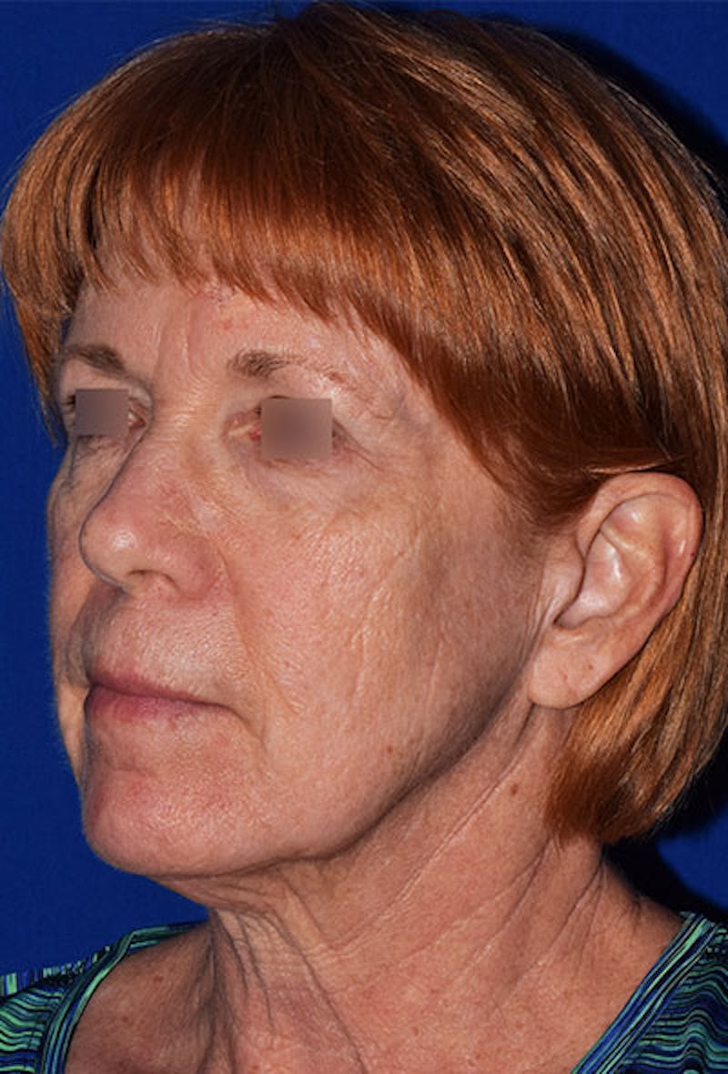 Face Before & After Gallery - Patient 63360865 - Image 3