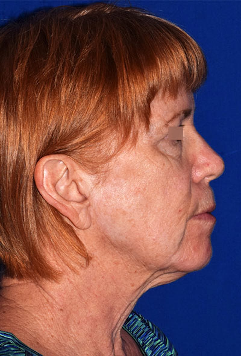 Cosmetic Surgical Before & After Gallery - Patient 63360865 - Image 5