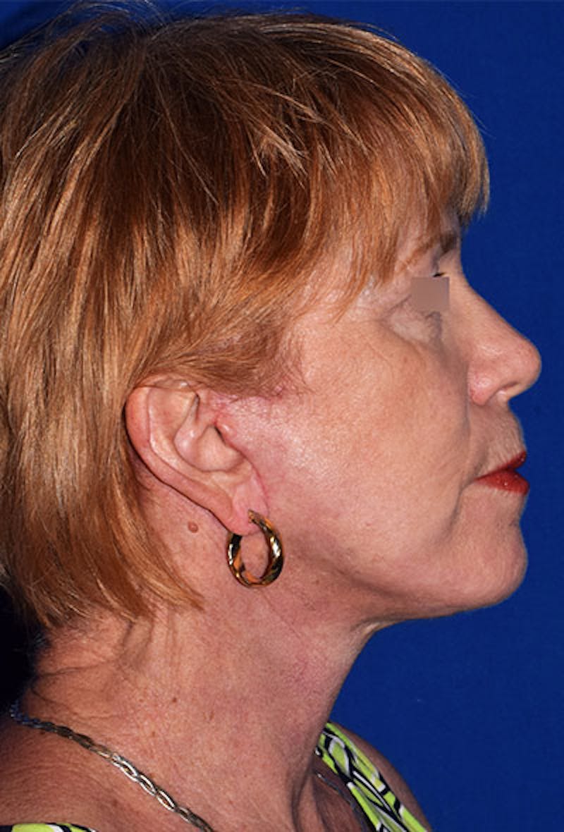 Cosmetic Surgical Before & After Gallery - Patient 63360865 - Image 6