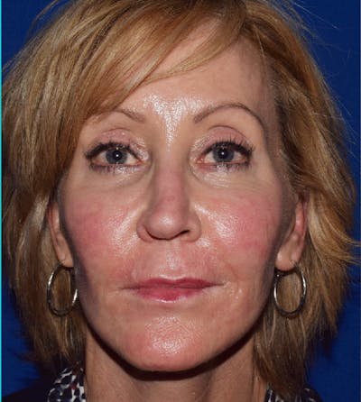 Cosmetic Surgical Before & After Gallery - Patient 63360869 - Image 1