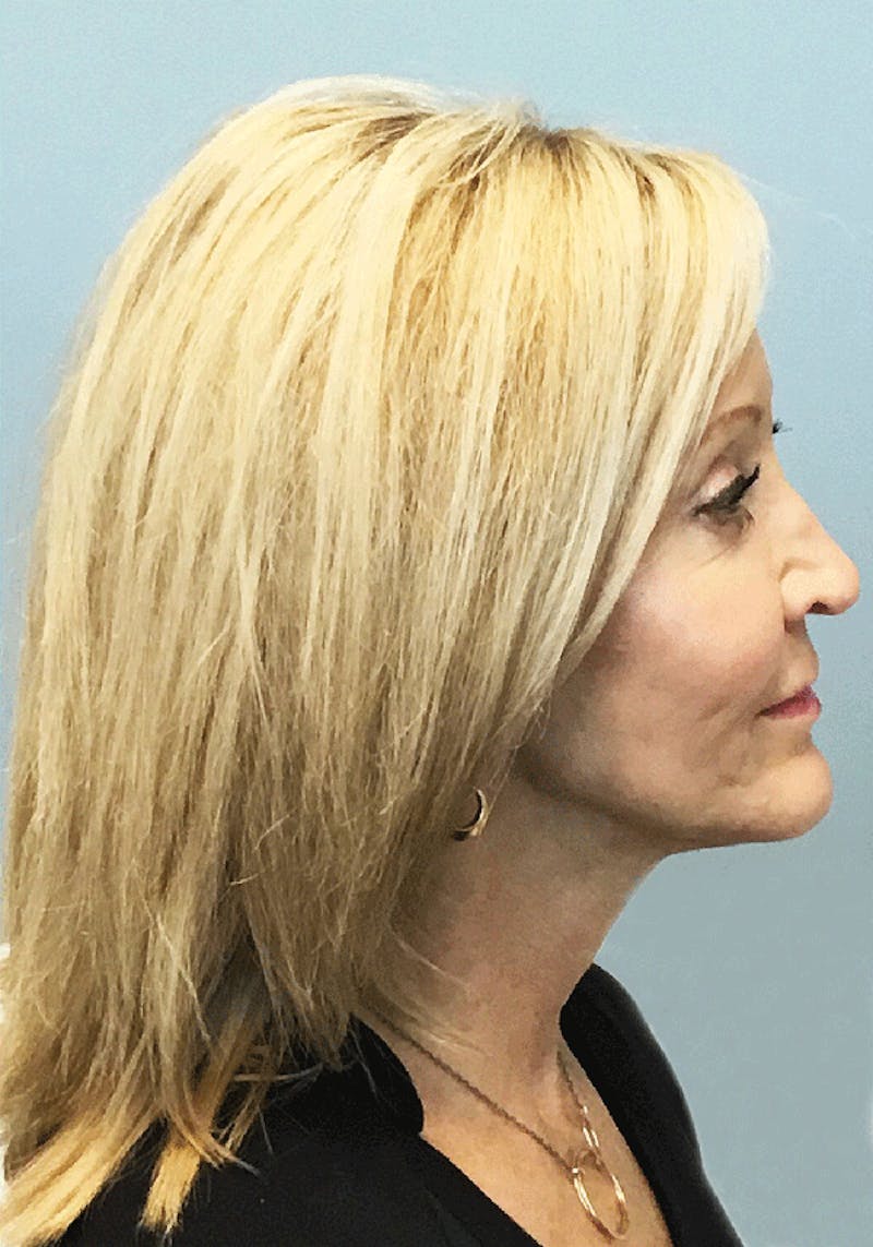 Face Before & After Gallery - Patient 63360869 - Image 6