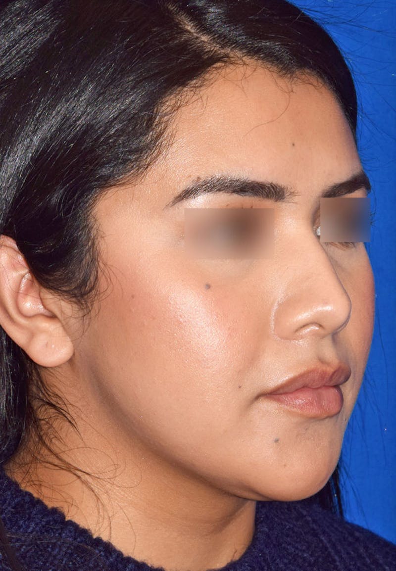 Face Before & After Gallery - Patient 63360871 - Image 1