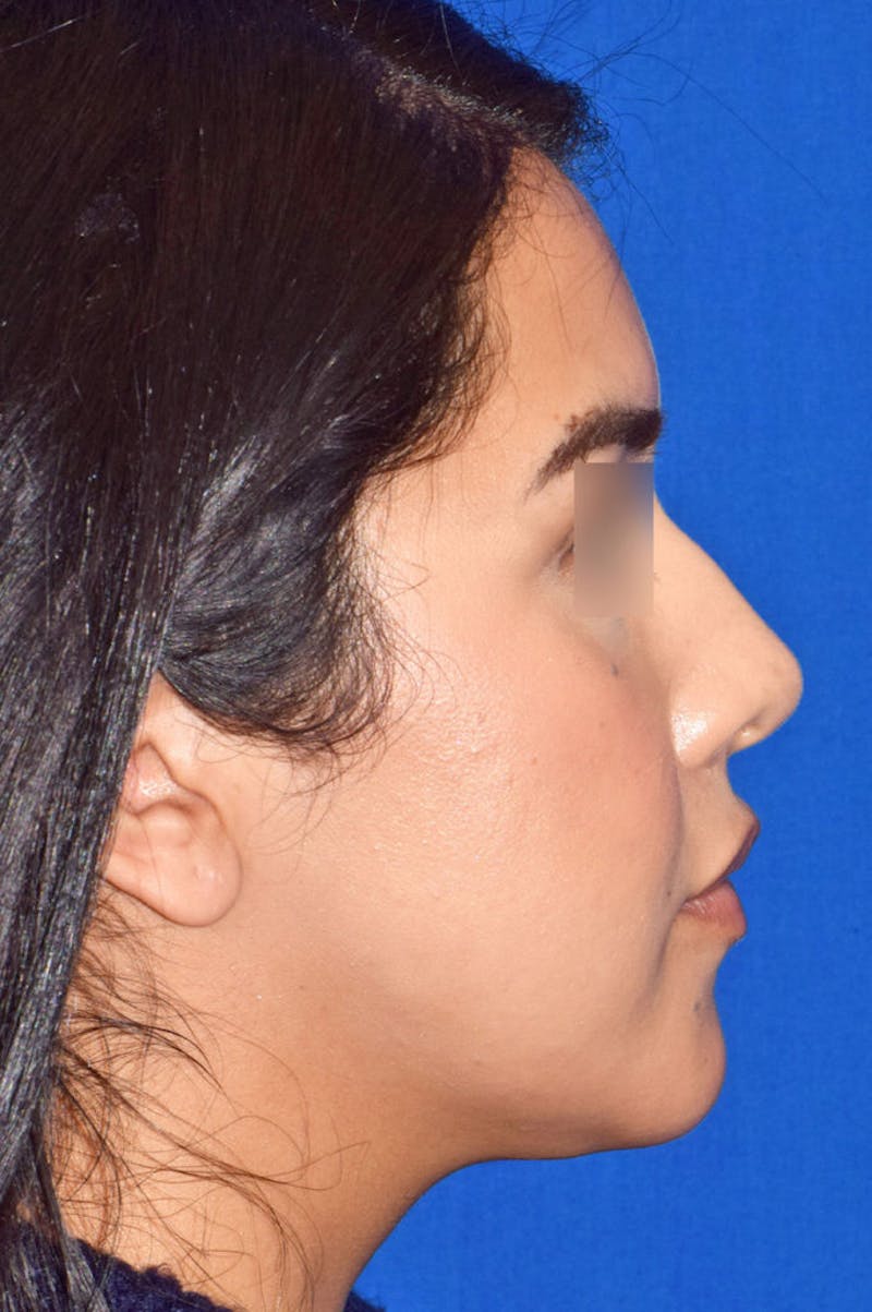 Cosmetic Surgical Before & After Gallery - Patient 63360871 - Image 3