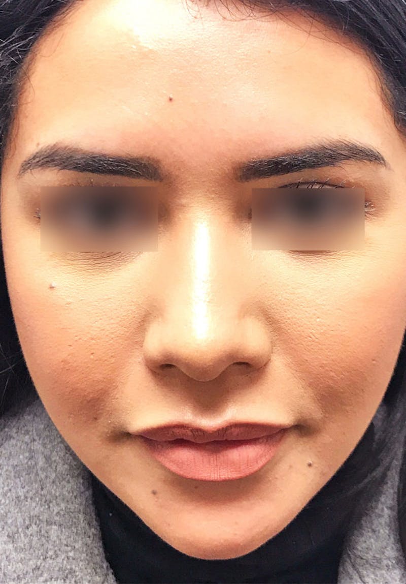 Face Before & After Gallery - Patient 63360871 - Image 6