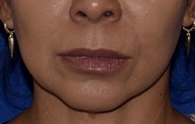 Face Before & After Gallery - Patient 63360872 - Image 1