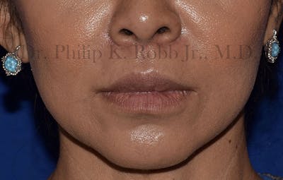 Face Before & After Gallery - Patient 63360872 - Image 2