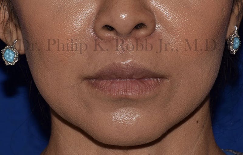 Cosmetic Surgical Before & After Gallery - Patient 63360872 - Image 2