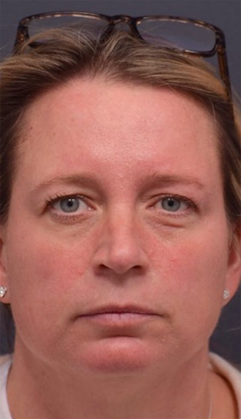 Face Before & After Gallery - Patient 63360875 - Image 1