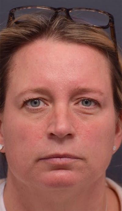 Cosmetic Surgical Before & After Gallery - Patient 63360875 - Image 1