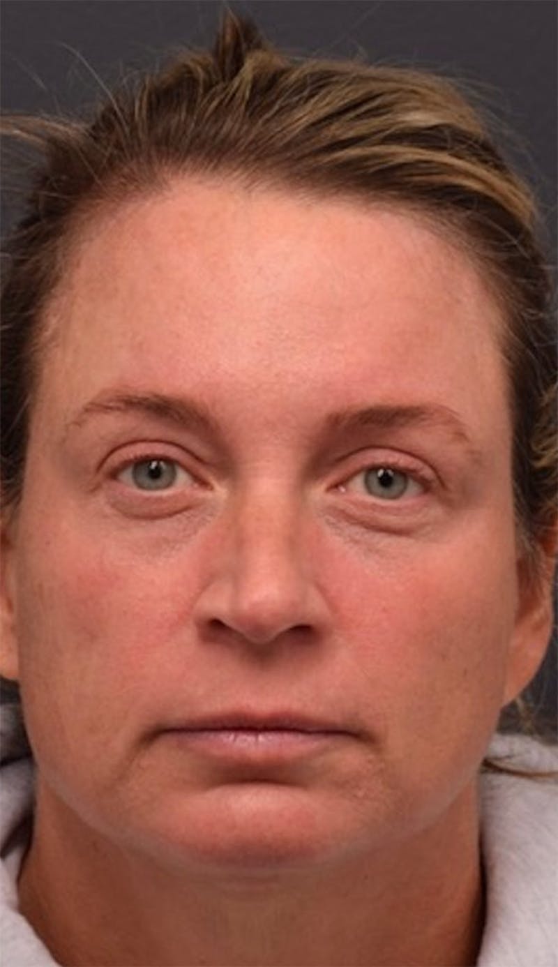Face Before & After Gallery - Patient 63360875 - Image 2