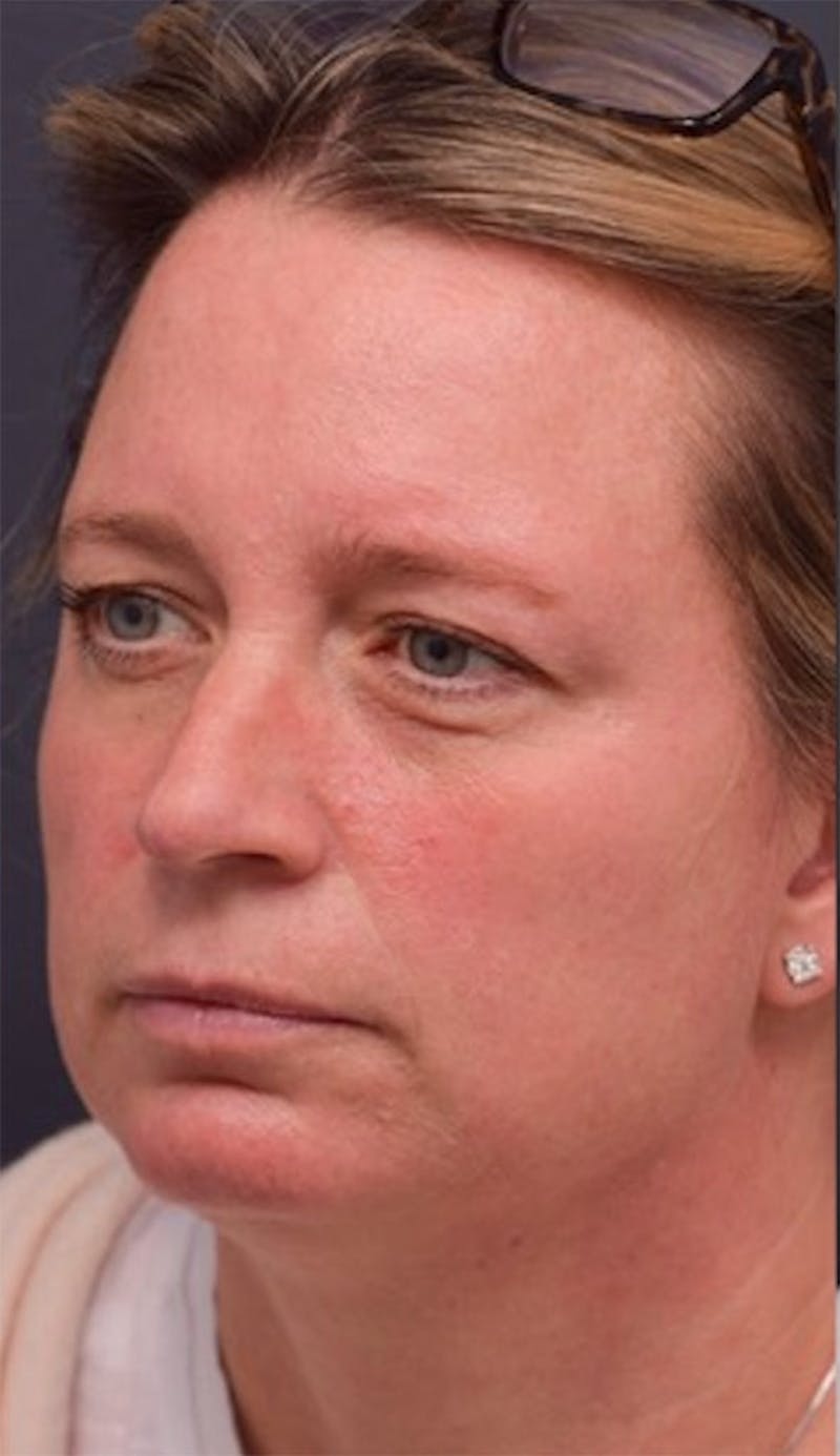 Face Before & After Gallery - Patient 63360875 - Image 3