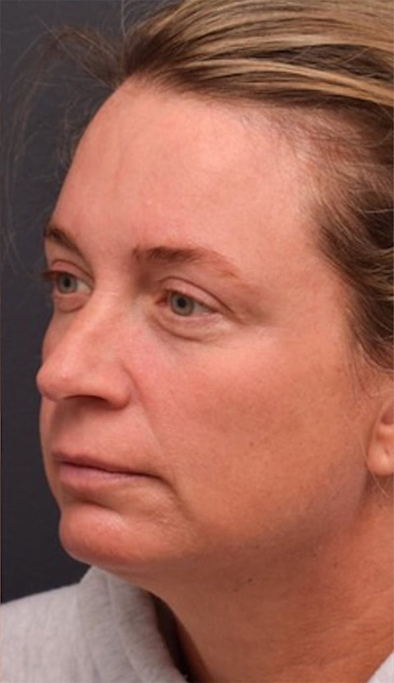 Face Before & After Gallery - Patient 63360875 - Image 4
