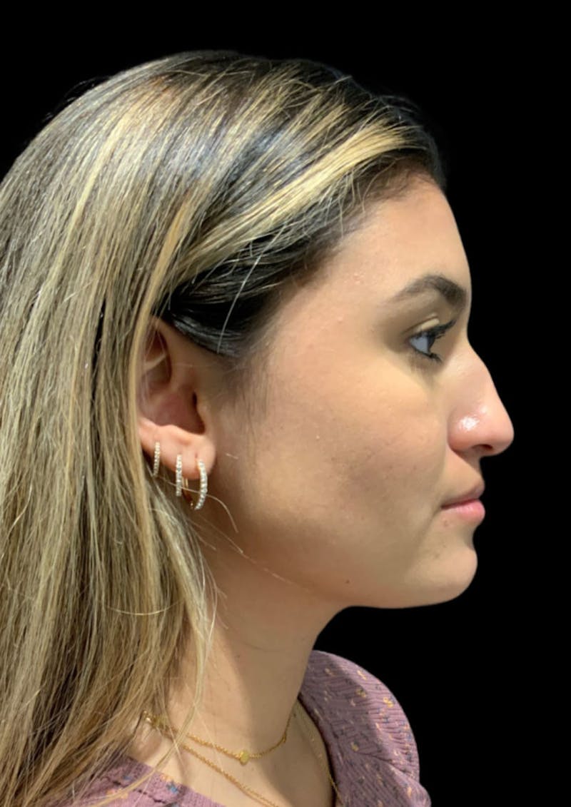 rhinoplasty surgery before and after