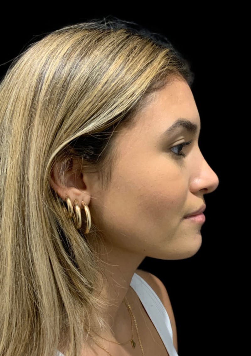 rhinoplasty surgery before and after