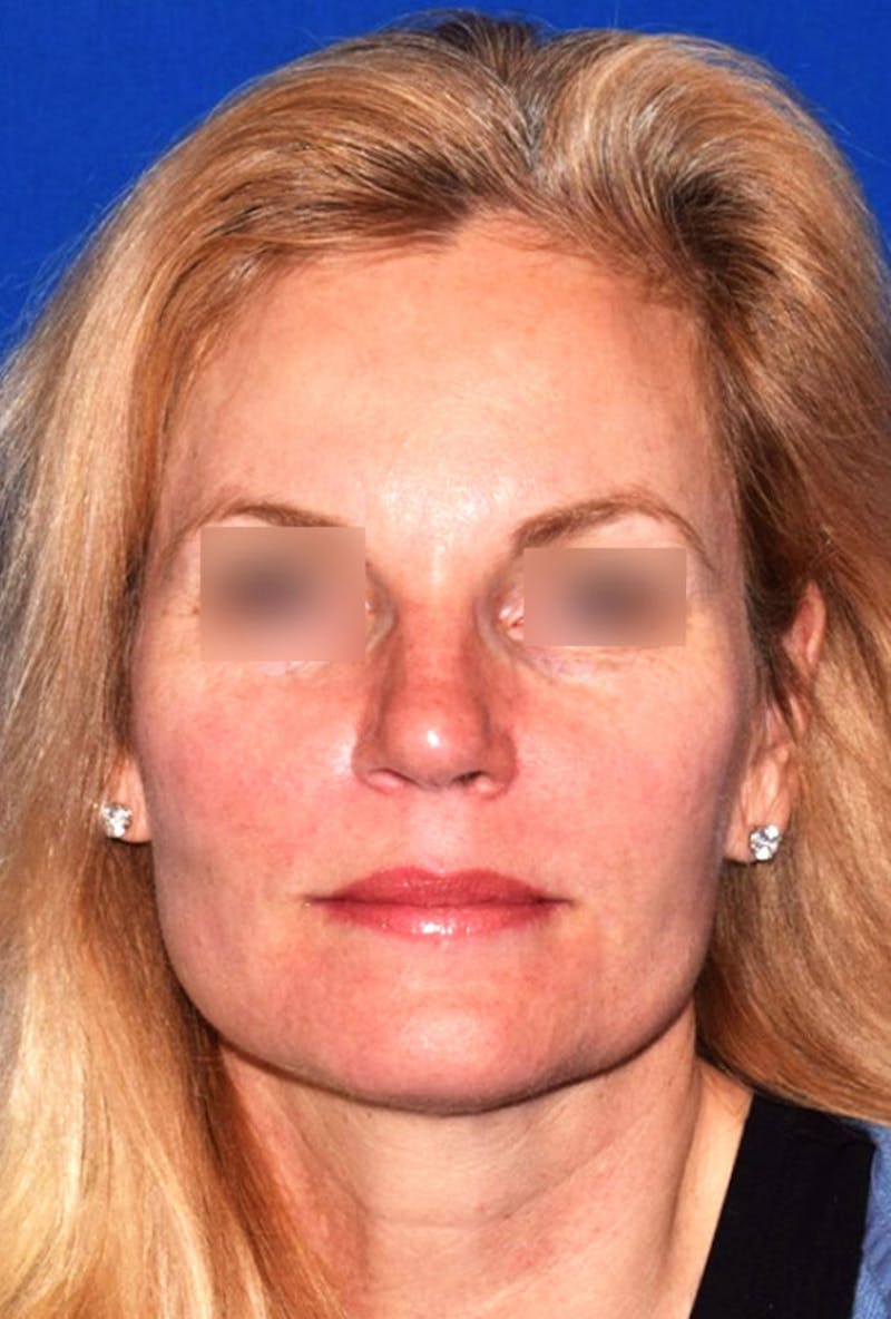 Face Before & After Gallery - Patient 63360880 - Image 2