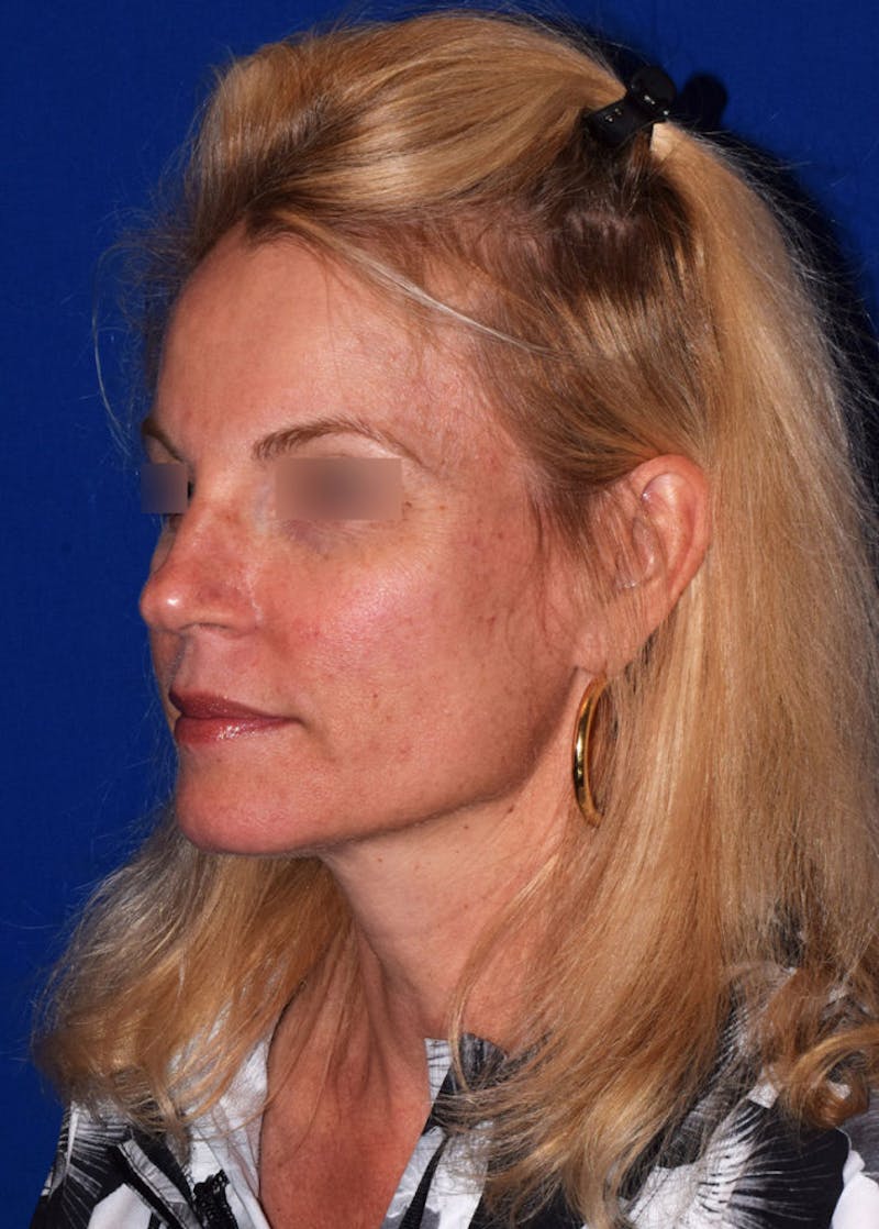 Face Before & After Gallery - Patient 63360880 - Image 3