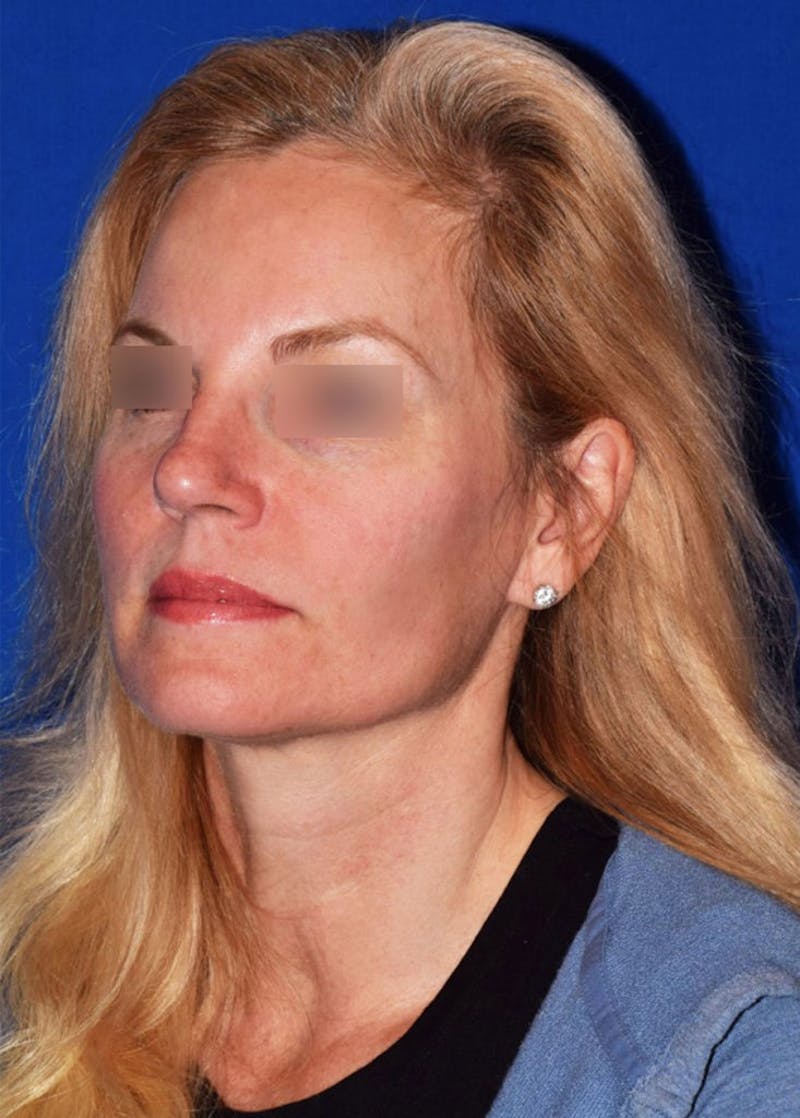 Face Before & After Gallery - Patient 63360880 - Image 4