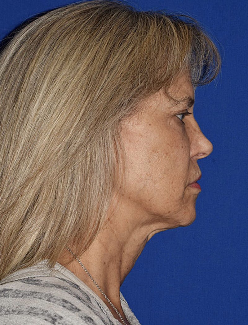 Face Before & After Gallery - Patient 63360883 - Image 5