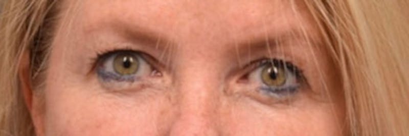 Face Before & After Gallery - Patient 63360885 - Image 1