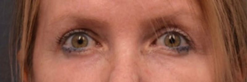 Face Before & After Gallery - Patient 63360885 - Image 2