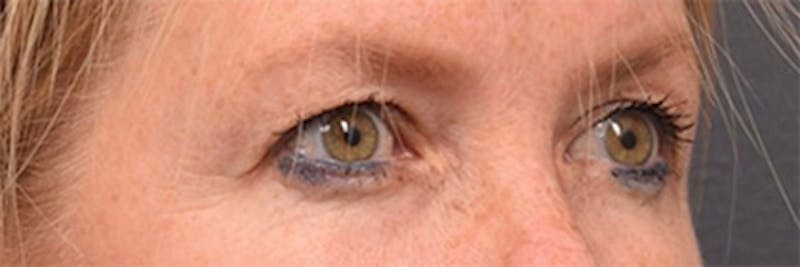 Face Before & After Gallery - Patient 63360885 - Image 3