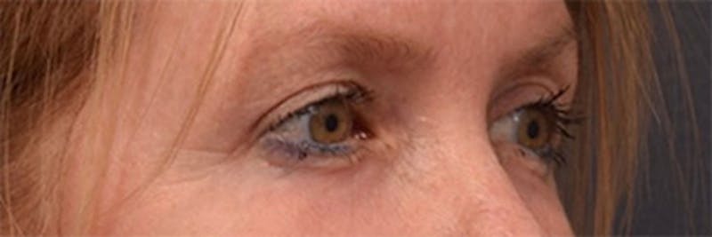 Face Before & After Gallery - Patient 63360885 - Image 4