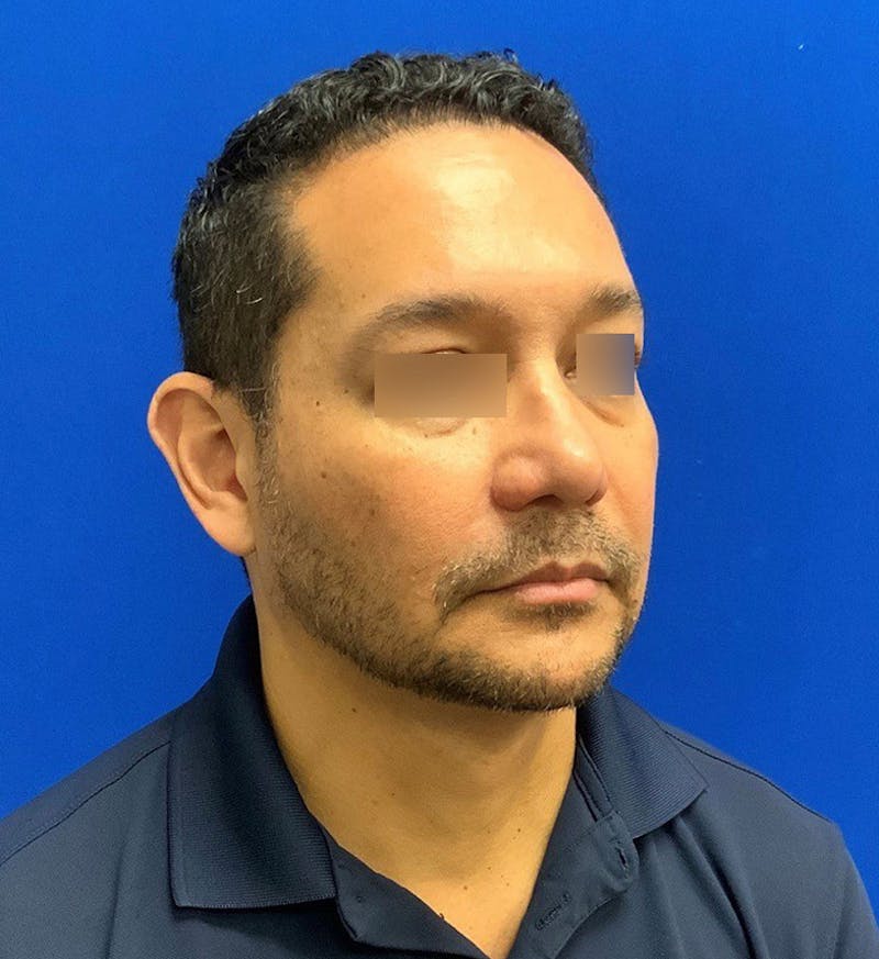 Face Before & After Gallery - Patient 63360888 - Image 1