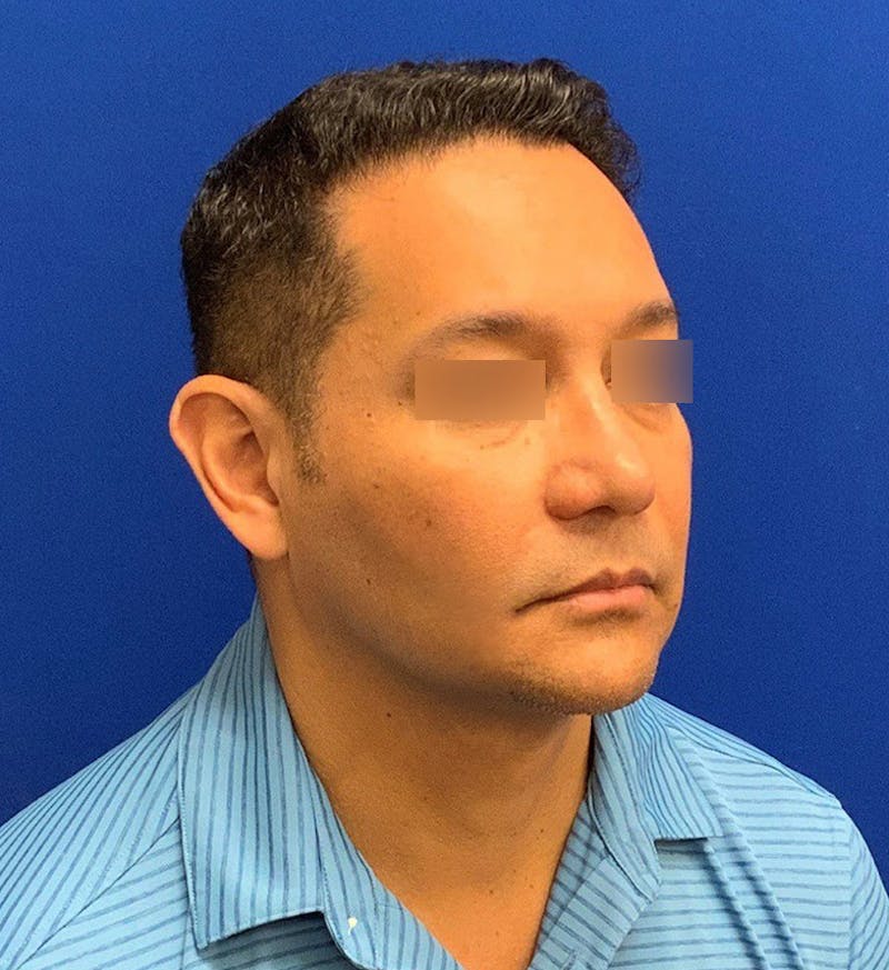 Face Before & After Gallery - Patient 63360888 - Image 2