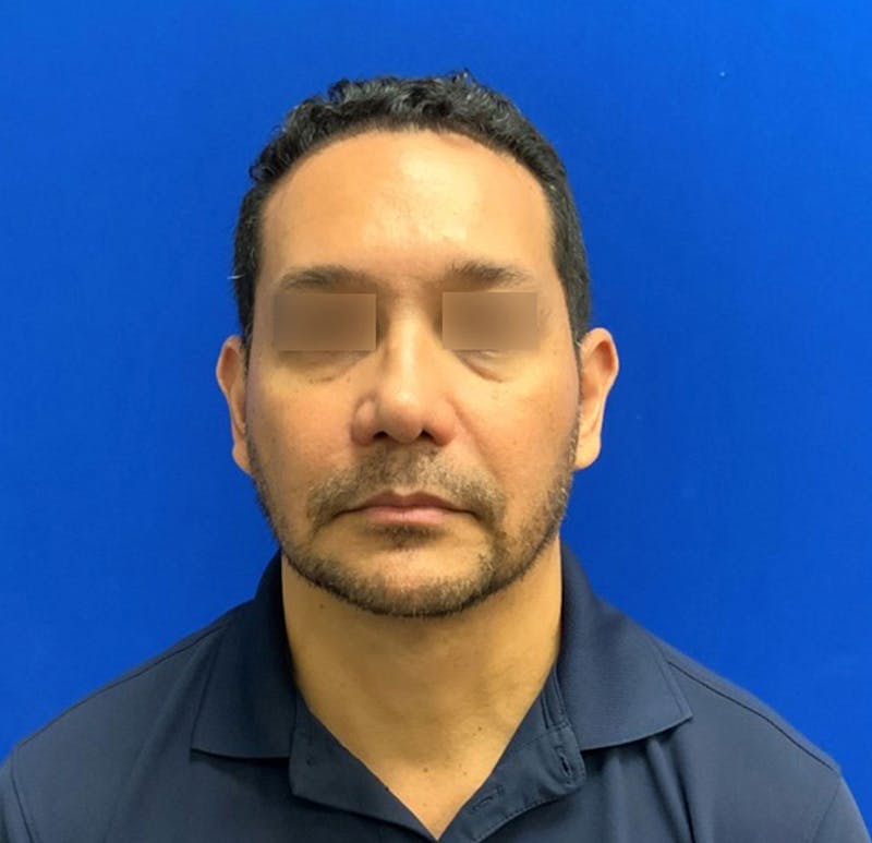 Face Before & After Gallery - Patient 63360888 - Image 3
