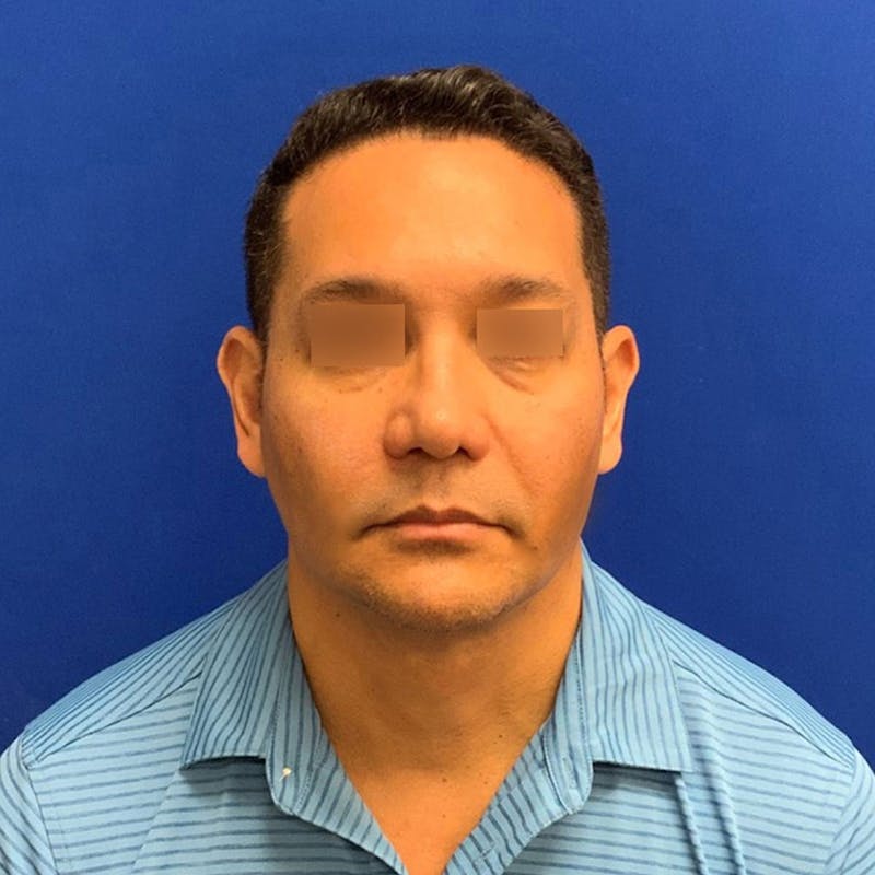 Face Before & After Gallery - Patient 63360888 - Image 4