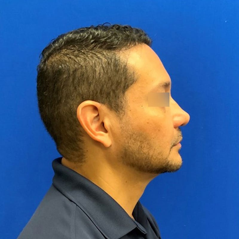 Face Before & After Gallery - Patient 63360888 - Image 5