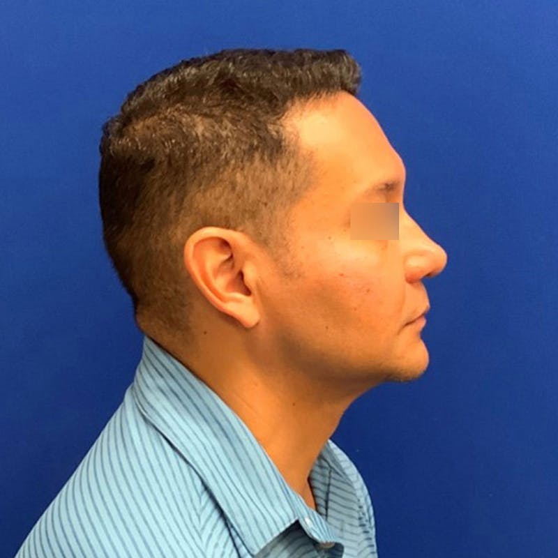 Face Before & After Gallery - Patient 63360888 - Image 6