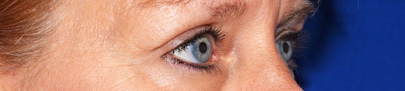 Face Before & After Gallery - Patient 63360895 - Image 3