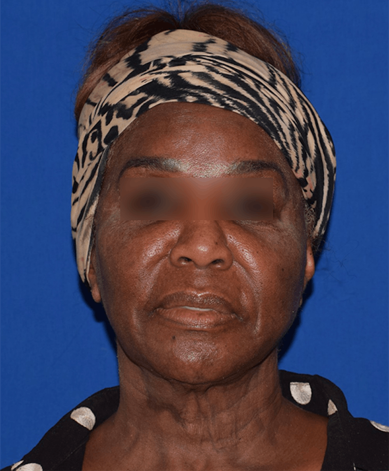Face Before & After Gallery - Patient 63360898 - Image 1